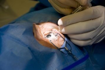 Cataract Surgery